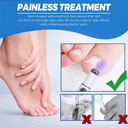 kalk nagel Schimmel Nagel Blue Light Laser Pen voor Niet-Invasieve Nagelverzorging